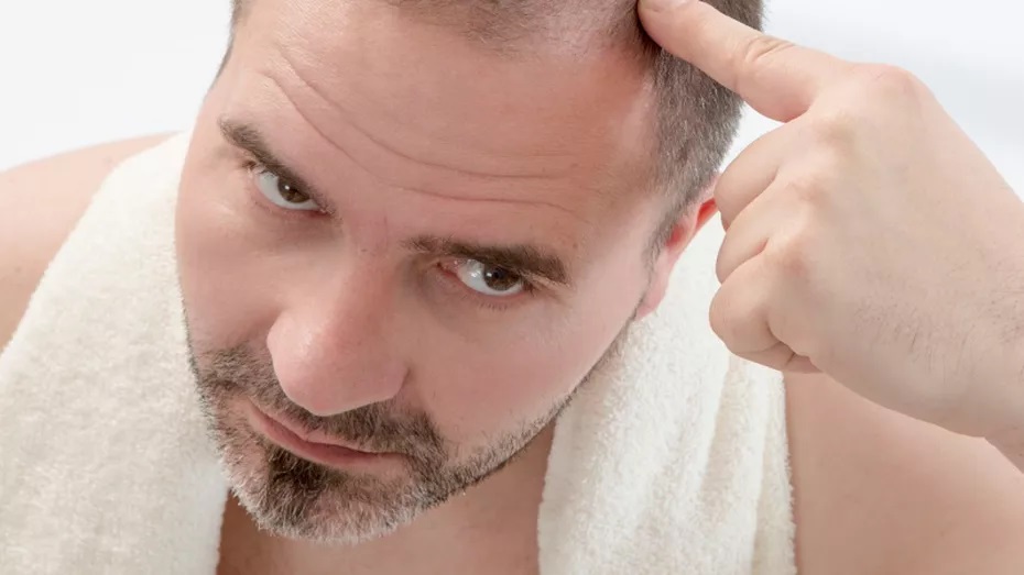 Alopecie: příčiny, léčba, prevence